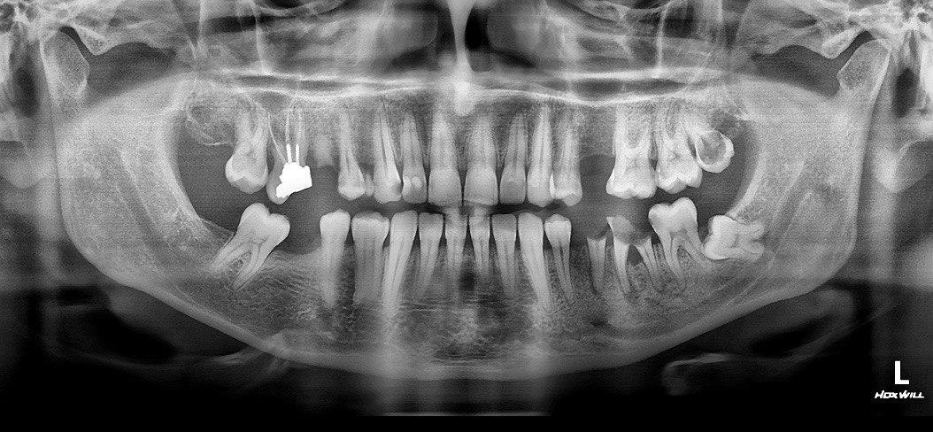 رادیوگرافی پانورامیک (OPG) چیست؟ مزایا و کاربرد