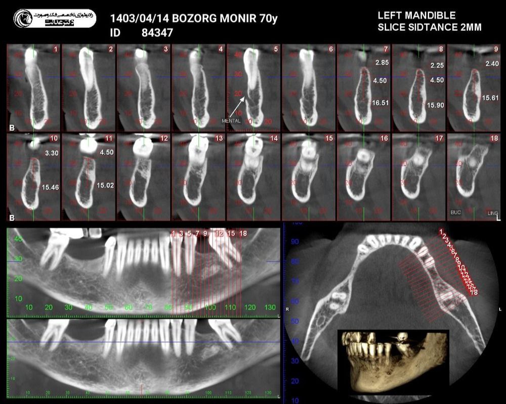 عکس CBCT دندان چیست؟ مزایا، معایب و کاربرد این روش